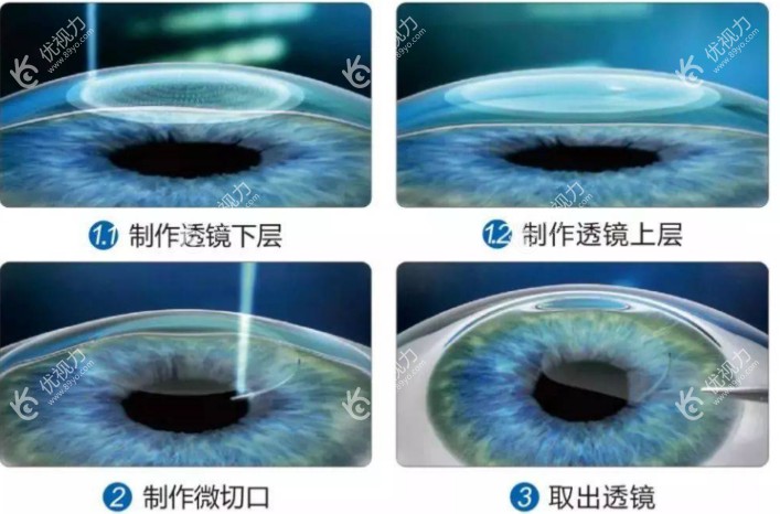 赵小虎医生做近视手术