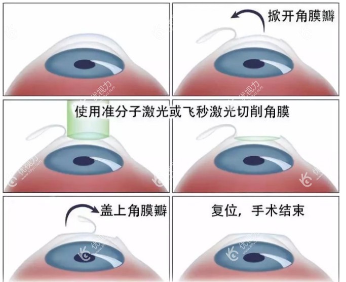 赵小虎医生做近视手术