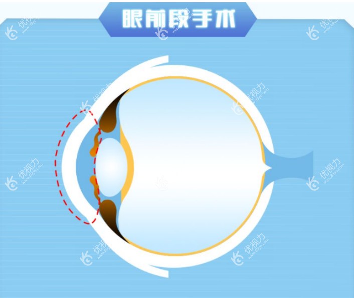 赵小虎医生近视手术