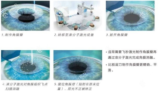广州视百年眼科做全飞秒激光手术优势